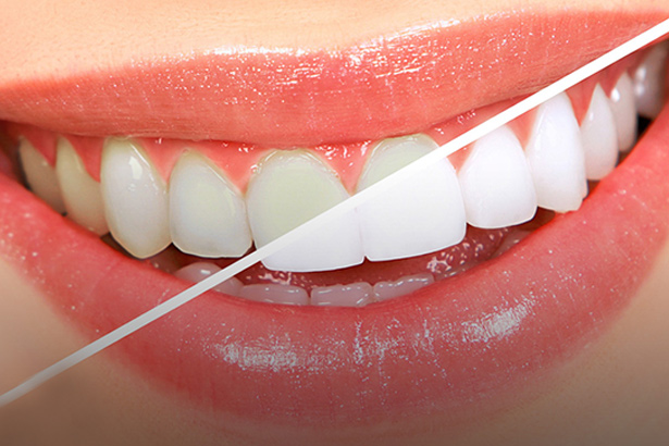 تاثیر هیدروژن پراکساید بر سفید کردن دندان