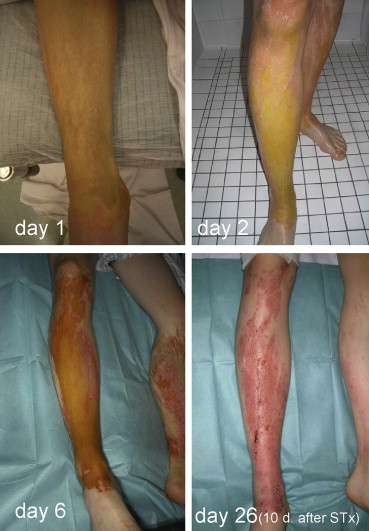 اشتباهات خطرناک در استفاده از اسید نیتریک